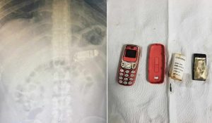 Doktorları şaşırtan ameliyat: Midesinden Nokia 3310 çıktı