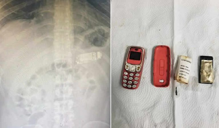 Doktorları şaşırtan ameliyat: Midesinden Nokia 3310 çıktı