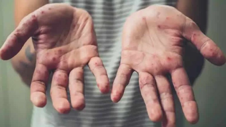 İngiltere’de maymun çiçeği vaka sayısı artıyor