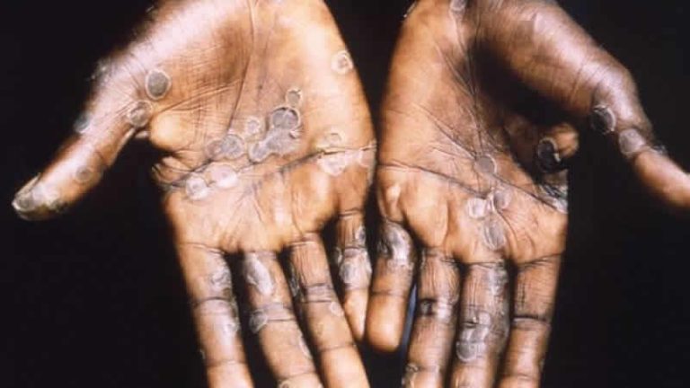 Avrupa’da maymun çiçeğinden ilk ölüm kayıtlara geçti