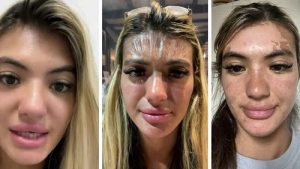 Güneş altında 30 dakika uyuyakaldı; alnı “plastik” gibi gerildi