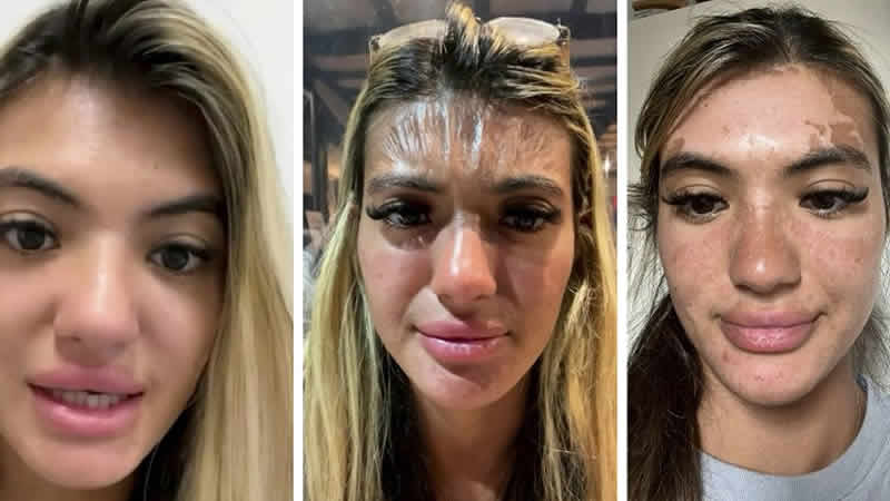 Güneş altında 30 dakika uyuyakaldı; alnı “plastik” gibi gerildi