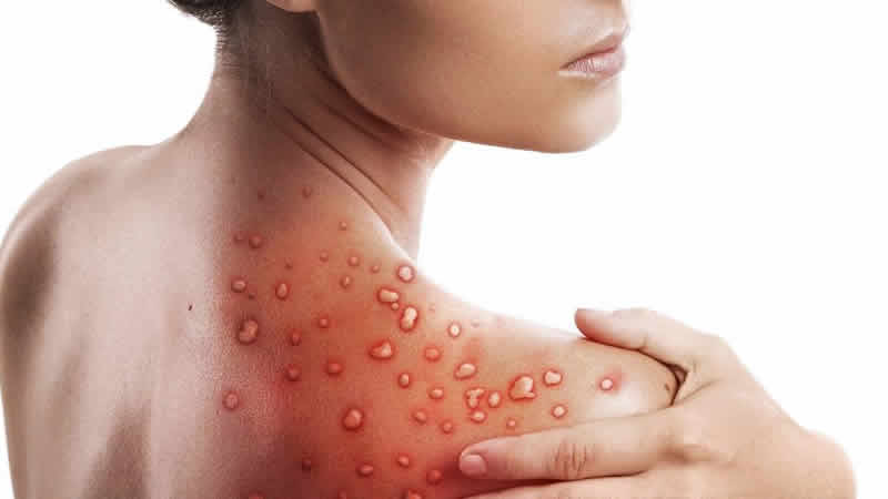 Maymun çiçeği nedeniyle ABD’nin bir eyaletinde daha OHAL ilan edildi