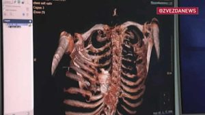 Patlamamış el bombası Rus askerin göğüs kafesine sıkıştı