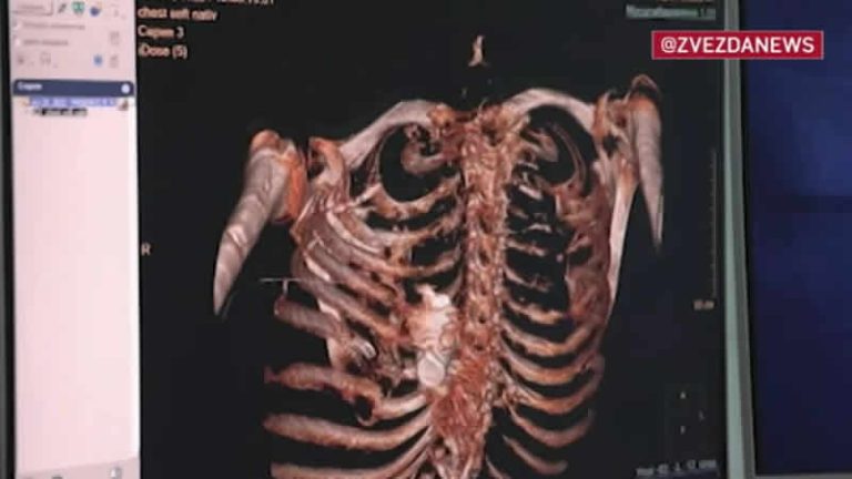 Patlamamış el bombası Rus askerin göğüs kafesine sıkıştı