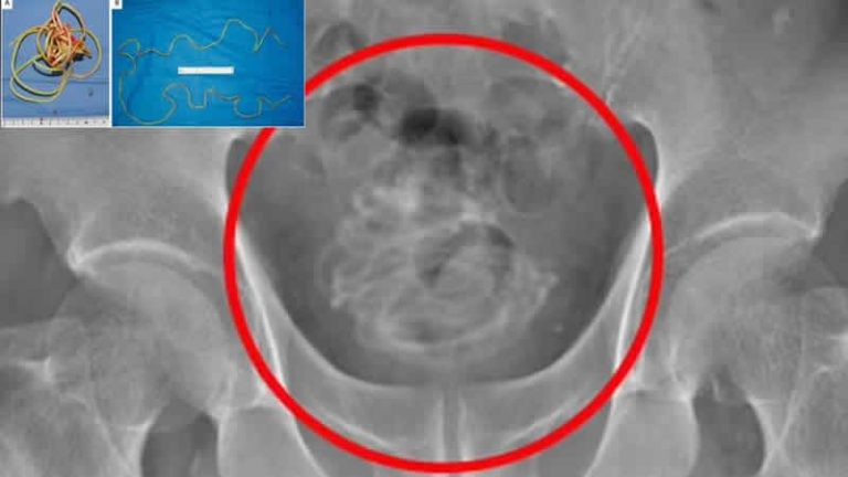 Penisinden 2 metrelik atlama ipi çıkarıldı!