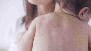 İngiltere’de genç doktorlara kızamık belirtilerin yeniden öğretiliyor!