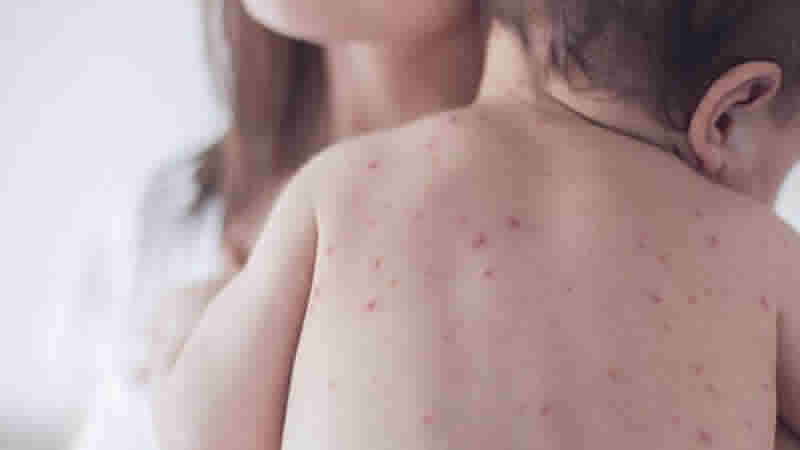 İngiltere’de genç doktorlara kızamık belirtilerin yeniden öğretiliyor!