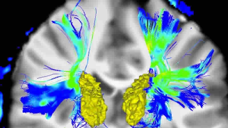 NHS yeni Parkinson ilacı Produodopa’yı satışa sunacak