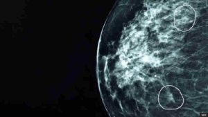 NHS’in test ettiği “Yapay Zeka Aracı” doktorların gözden kaçırdığı küçük kanserleri tespit ediyor