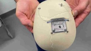 Dünyada bir ilk: İngiltere’de 13 yaşındaki çocuğun kafatasına epilepsi cihazı yerleştirildi