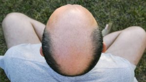 İngiltere Yüksek Mahkemesi, “Kel” Sözcüğünü Cinsel Taciz Olarak Değerlendirdi